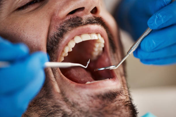 Best Emergency Tooth Extraction in Beverly, OH